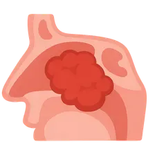Tumors of the Nose and Paranasal Sinuses