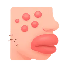 Urticaria and Angioedema