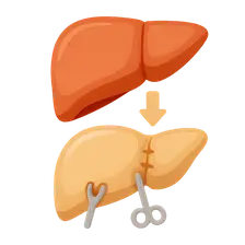 Liver Transplantation