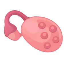 Polycystic Ovary Syndrome