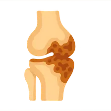 Tuberculosis of Bones and Joints