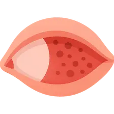 Conjunctival Manifestations of Systemic Diseases