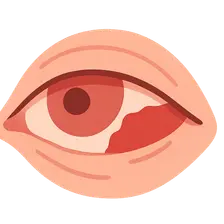 Subconjunctival Hemorrhage