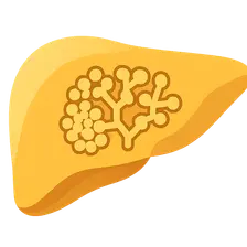GSD type IV (Andersen disease)