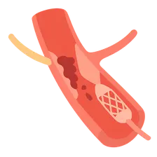 Reperfusion strategies (fibrinolysis vs PCI)