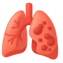 Acute respiratory distress syndrome