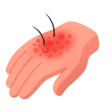 Allergic Contact Dermatitis in Workplace