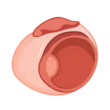 Complications of Refractive Surgery