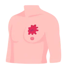 Male breast cancer