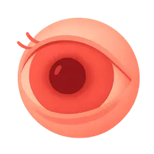 Scleritis: Anterior