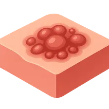 Herpes Simplex Virus Infections