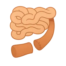 Small bowel resection and anastomosis