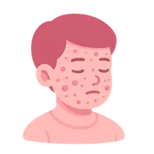 Acne in Childhood and Adolescence