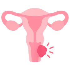 Vulvodynia