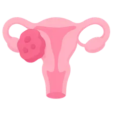 Vulvar and Vaginal Cancer