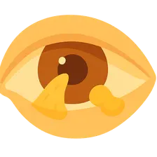 Pterygium and Pinguecula