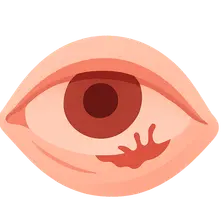 Conjunctival Trauma