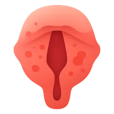 Acute Laryngitis