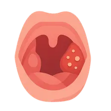 Tonsillitis