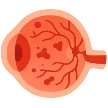 Hypertension