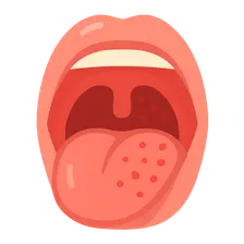 Pharyngitis