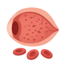 Hematological Disorders