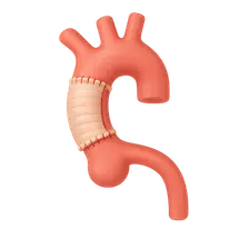 Aortic dissection management