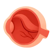 Retinal Detachment