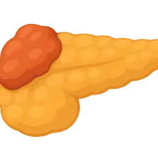 Pancreatic diseases