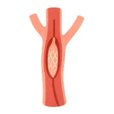 Endovascular Techniques