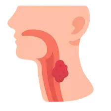 Hypopharyngeal Cancer