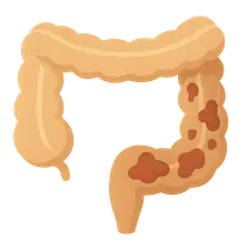 Inflammatory Bowel Disease