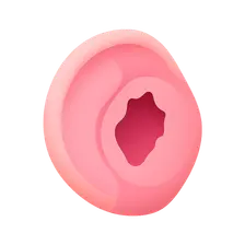 Tympanic Membrane Perforation