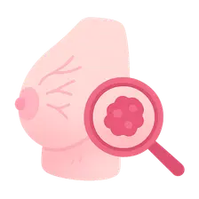 Breast Cancer: Diagnosis and Staging