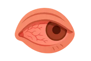 Diseases of the Conjunctiva