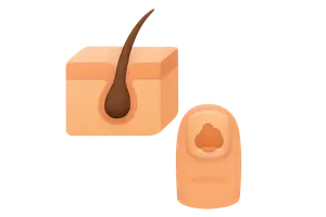 Hair and Nail Disorders