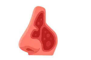 Diseases of the Nose and Paranasal Sinuses