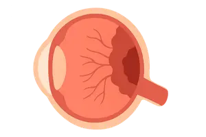 Diseases of the Retina