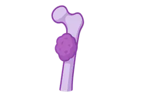 Musculoskeletal Oncology