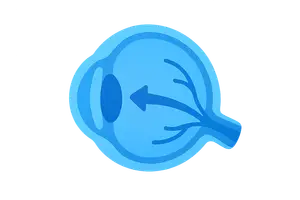 Glaucoma