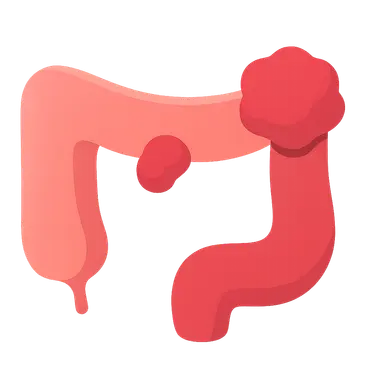 Colon polyps and neoplasms