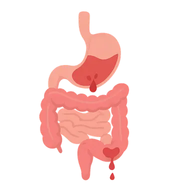 GI bleeding (upper and lower)