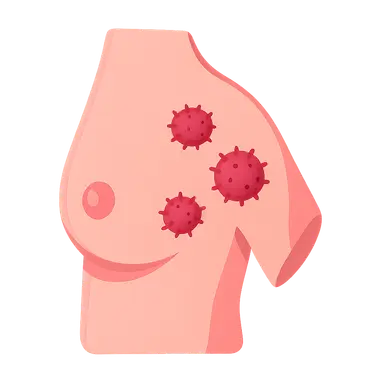 Hereditary breast cancer syndromes