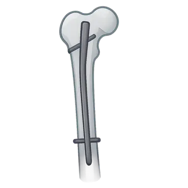 Intramedullary Nailing