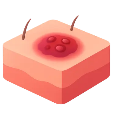 Soft Tissue Infections