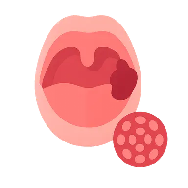 Oropharyngeal Cancer and HPV