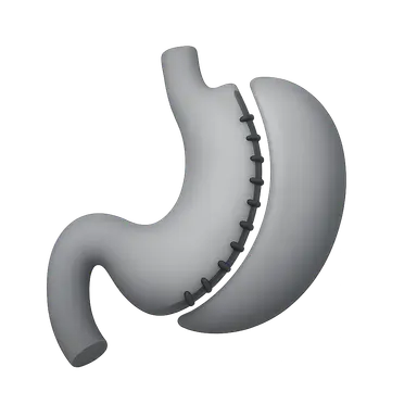 Revisional Bariatric Surgery