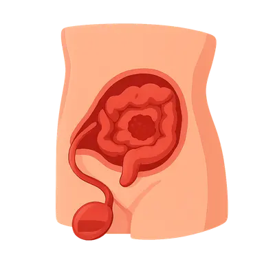 Hyperthermic Intraperitoneal Chemotherapy