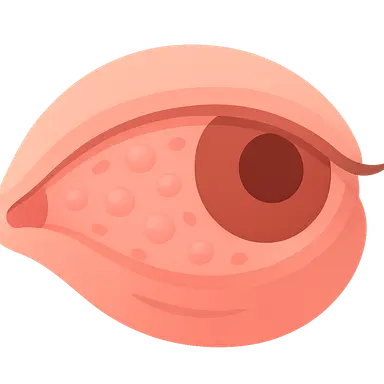 Conjunctivitis: Chronic