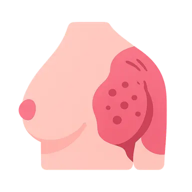 Post-mastectomy complications